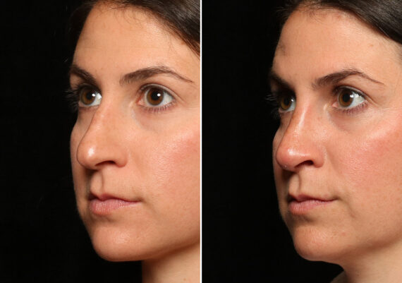 Rhinoplasty (Nose Reshaping) Before and After Photos in Cincinnati, OH, Patient 12701