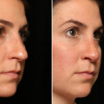 Rhinoplasty (Nose Reshaping) Before and After Photos in Cincinnati, OH, Patient 12701