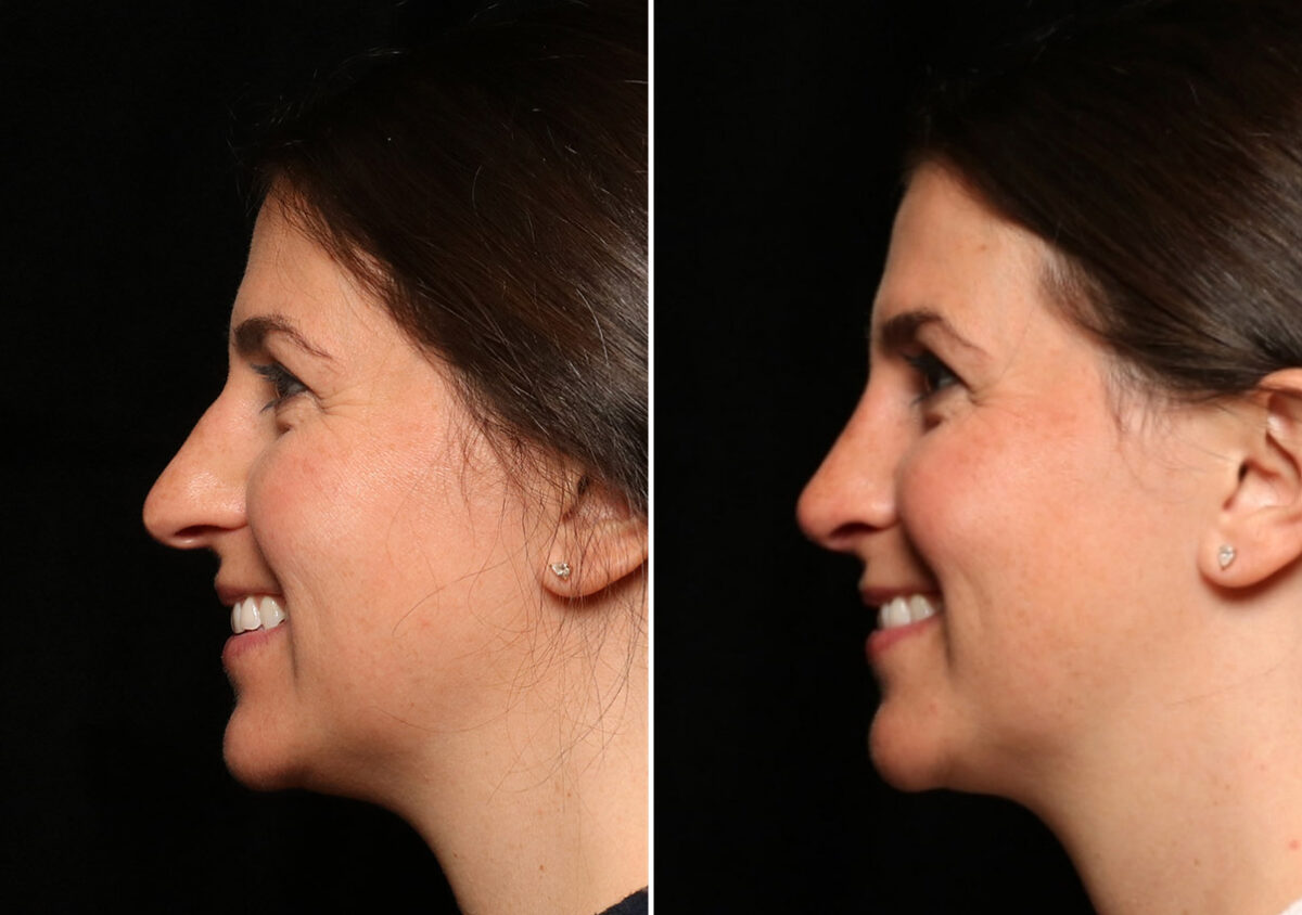 Rhinoplasty (Nose Reshaping) Before and After Photos in Cincinnati, OH, Patient 12701