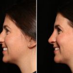 Rhinoplasty (Nose Reshaping) Before and After Photos in Cincinnati, OH, Patient 12701