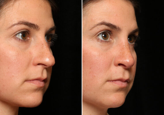 Rhinoplasty (Nose Reshaping) Before and After Photos in Cincinnati, OH, Patient 12701