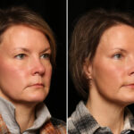 Blepharoplasty Before and After Photos in Cincinnati, OH, Patient 12718