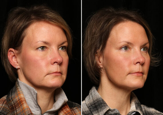 Blepharoplasty Before and After Photos in Cincinnati, OH, Patient 12718