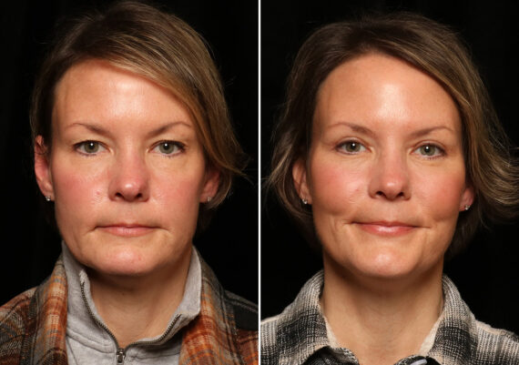 Blepharoplasty Before and After Photos in Cincinnati, OH, Patient 12718