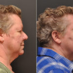 Rhinoplasty (Nose Reshaping) Before and After Photos in Cincinnati, OH, Patient 6988