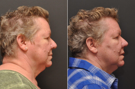 Rhinoplasty (Nose Reshaping) Before and After Photos in Cincinnati, OH, Patient 6988