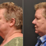 Rhinoplasty (Nose Reshaping) Before and After Photos in Cincinnati, OH, Patient 6988