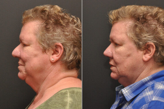 Rhinoplasty (Nose Reshaping) Before and After Photos in Cincinnati, OH, Patient 6988