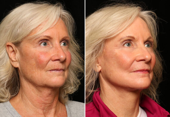 LuxeLift Before and After Photos in Cincinnati, OH, Patient 12813