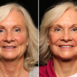 LuxeLift Before and After Photos in Cincinnati, OH, Patient 12813