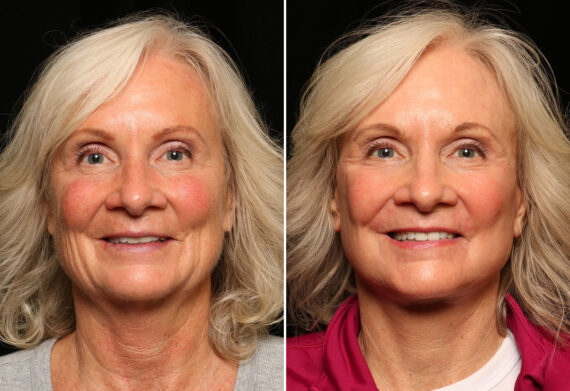 LuxeLift Before and After Photos in Cincinnati, OH, Patient 12813