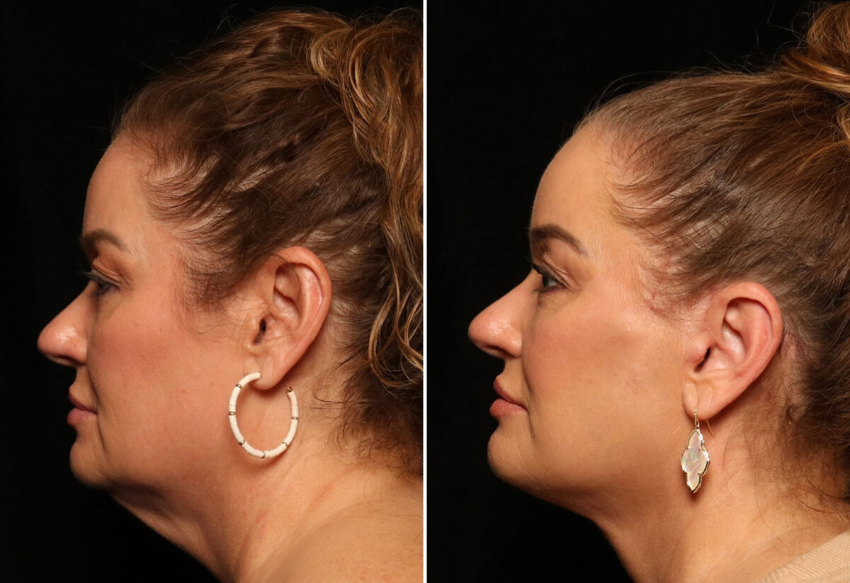 LuxeLift Before and After Photos in Cincinnati, OH, Patient 12820