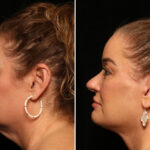 LuxeLift Before and After Photos in Cincinnati, OH, Patient 12820