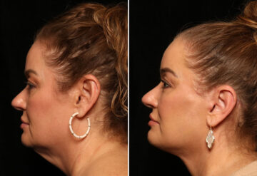 LuxeLift Before and After Photos in Cincinnati, OH, Patient 12820