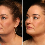 LuxeLift Before and After Photos in Cincinnati, OH, Patient 12820