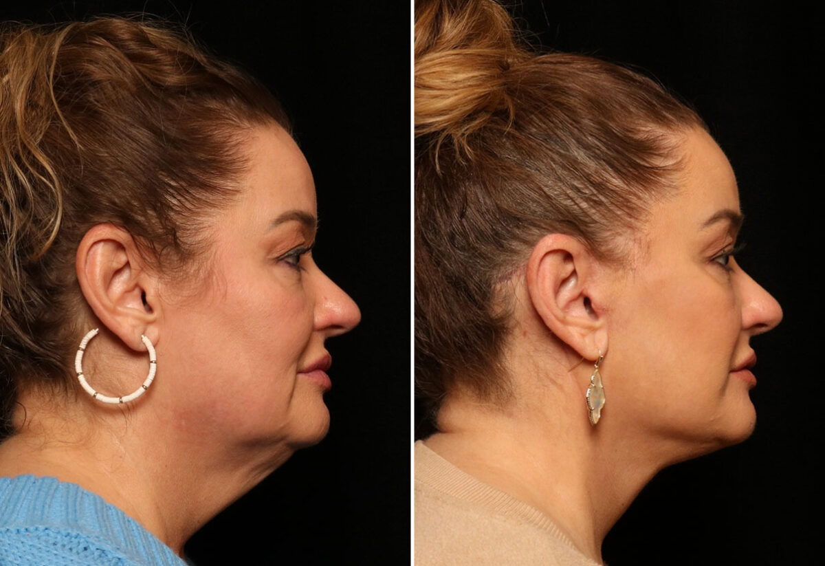 LuxeLift Before and After Photos in Cincinnati, OH, Patient 12820