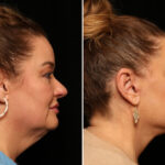 LuxeLift Before and After Photos in Cincinnati, OH, Patient 12820
