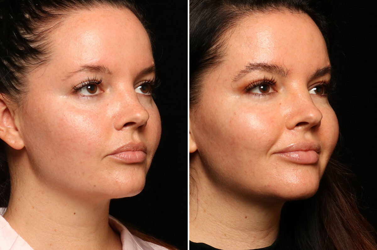 Hair Transplantation Before and After Photos in Cincinnati, OH, Patient 12830