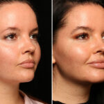 Hair Transplantation Before and After Photos in Cincinnati, OH, Patient 12830