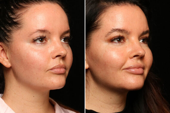 Hair Transplantation Before and After Photos in Cincinnati, OH, Patient 12830