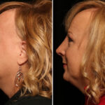Rhinoplasty (Nose Reshaping) Before and After Photos in Cincinnati, OH, Patient 12837