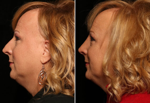 Rhinoplasty (Nose Reshaping) Before and After Photos in Cincinnati, OH, Patient 12837