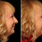 Rhinoplasty (Nose Reshaping) Before and After Photos in Cincinnati, OH, Patient 12837