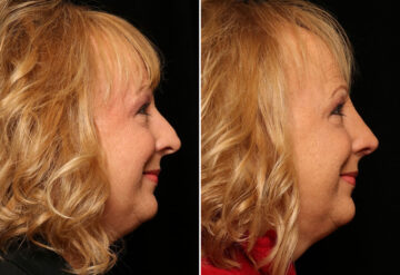 Rhinoplasty (Nose Reshaping) Before and After Photos in Cincinnati, OH, Patient 12837