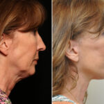 Facial Liposuction Before and After Photos in Cincinnati, OH, Patient 14419