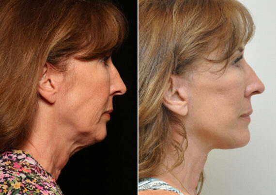 Facial Liposuction Before and After Photos in Cincinnati, OH, Patient 14419