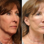 Facial Liposuction Before and After Photos in Cincinnati, OH, Patient 14419