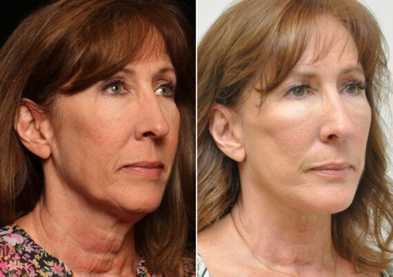 Facial Liposuction Before and After Photos in Cincinnati, OH, Patient 14419