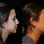 Rhinoplasty (Nose Reshaping) Before and After Photos in Cincinnati, OH, Patient 14426