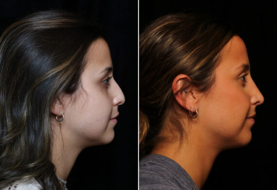 Rhinoplasty (Nose Reshaping) Before and After Photos in Cincinnati, OH