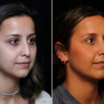 Rhinoplasty (Nose Reshaping) Before and After Photos in Cincinnati, OH, Patient 14426