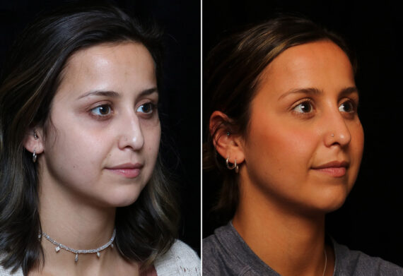 Rhinoplasty (Nose Reshaping) Before and After Photos in Cincinnati, OH, Patient 14426