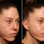 Blepharoplasty Before and After Photos in Cincinnati, OH, Patient 14434