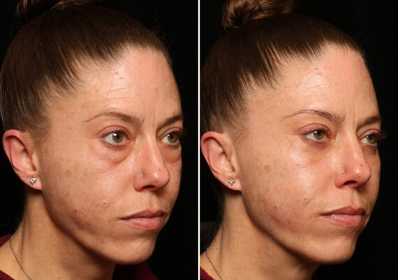 Blepharoplasty Before and After Photos in Cincinnati, OH, Patient 14434