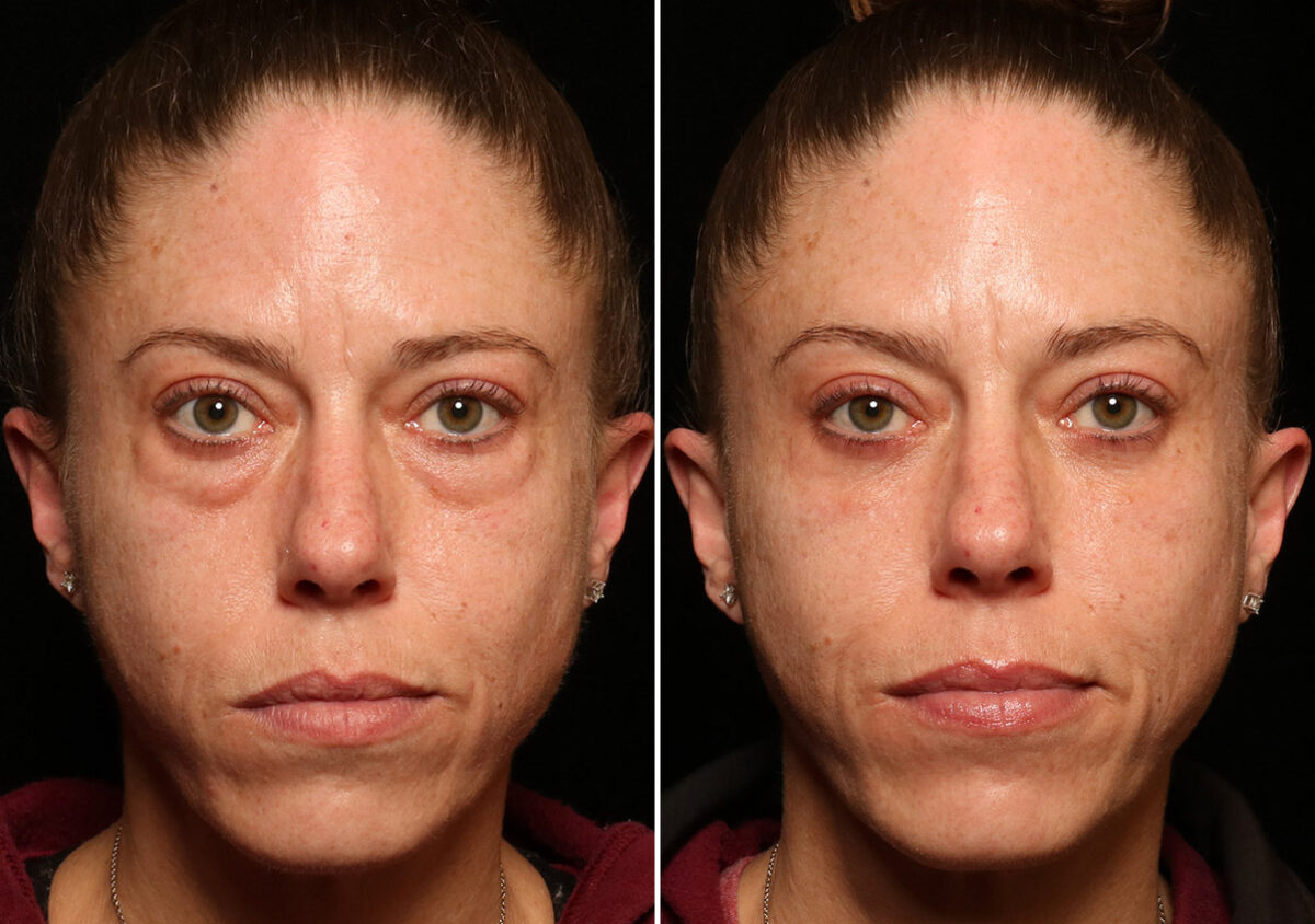 Blepharoplasty Before and After Photos in Cincinnati, OH, Patient 14434