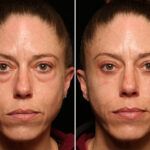 Blepharoplasty Before and After Photos in Cincinnati, OH, Patient 14434