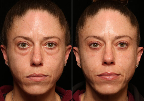 Blepharoplasty Before and After Photos in Cincinnati, OH, Patient 14434