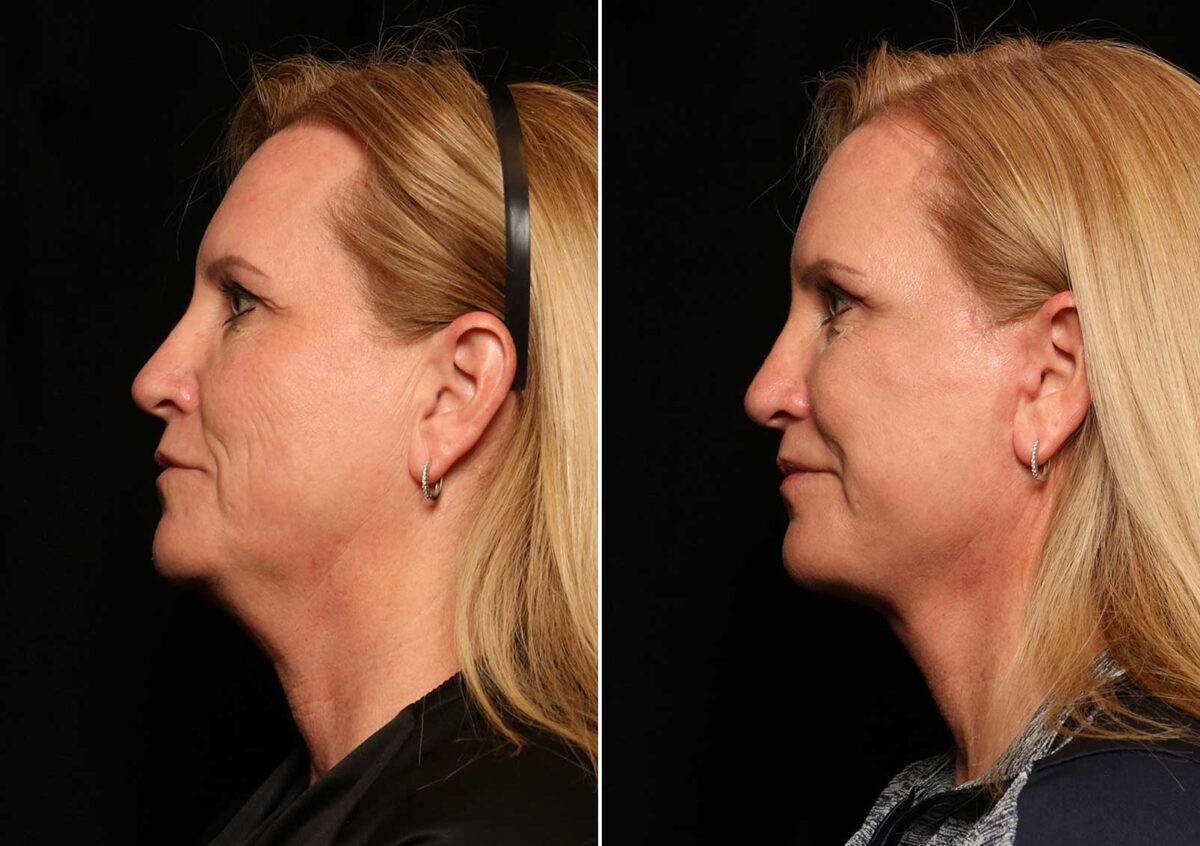 Blepharoplasty Before and After Photos in Cincinnati, OH, Patient 14455