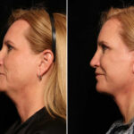 Blepharoplasty Before and After Photos in Cincinnati, OH, Patient 14455