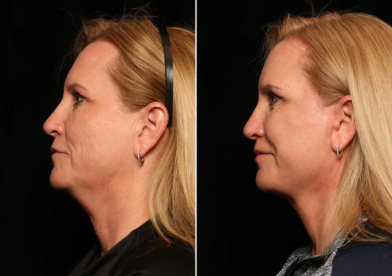 Blepharoplasty Before and After Photos in Cincinnati, OH, Patient 14455