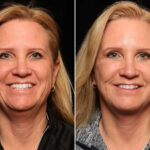 Blepharoplasty Before and After Photos in Cincinnati, OH, Patient 14455