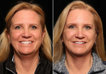 Blepharoplasty Before and After Photos in Cincinnati, OH, Patient 14455