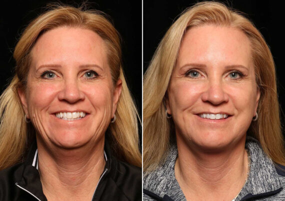 Facial Liposuction Before and After Photos in Cincinnati, OH