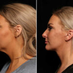 LuxeLift Before and After Photos in Cincinnati, OH, Patient 14462