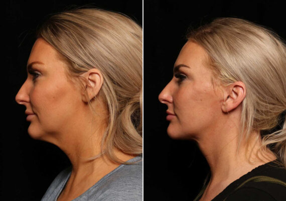 LuxeLift Before and After Photos in Cincinnati, OH, Patient 14462