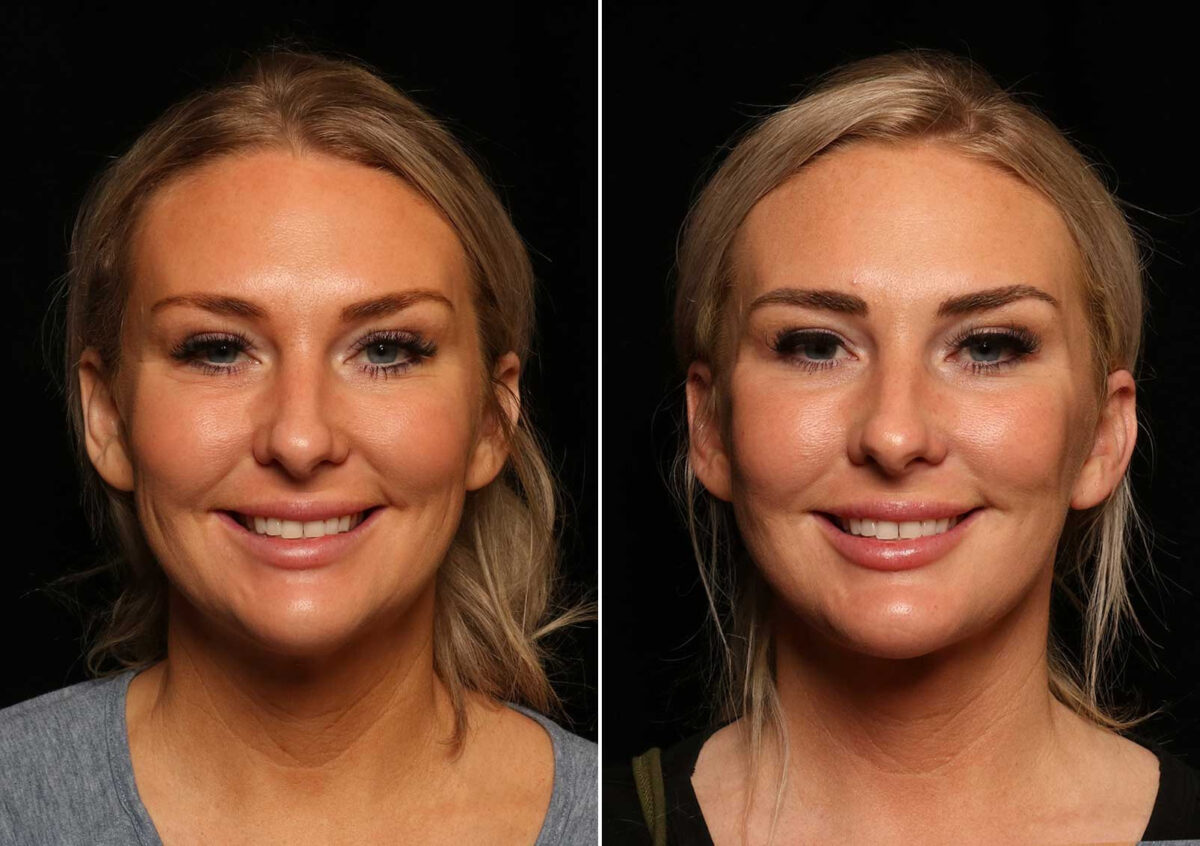LuxeLift Before and After Photos in Cincinnati, OH, Patient 14462